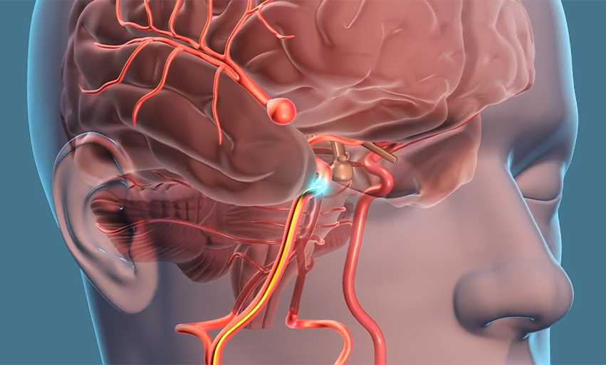 What are Brain Aneurysms?